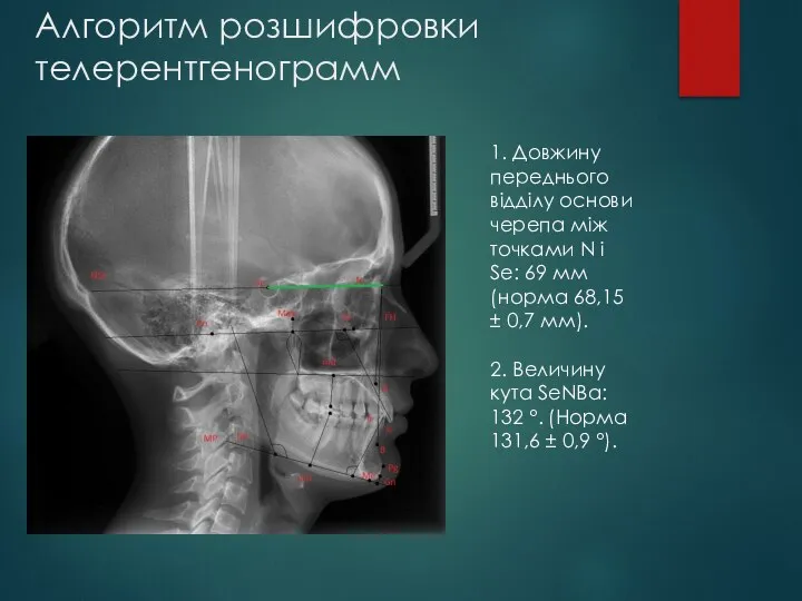 Алгоритм розшифровки телерентгенограмм 1. Довжину переднього відділу основи черепа між точками N