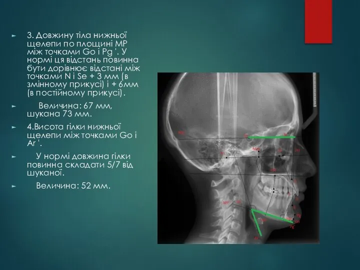 3. Довжину тіла нижньої щелепи по площині МP між точками Go і