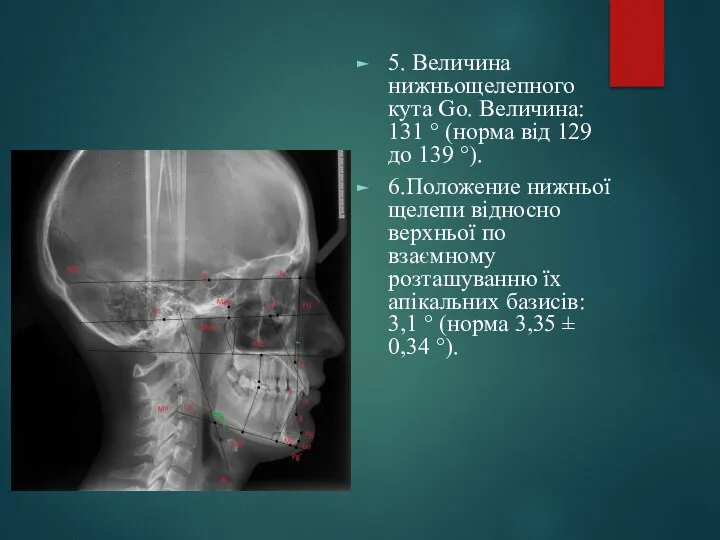 5. Величина нижньощелепного кута Go. Величина: 131 ° (норма від 129 до