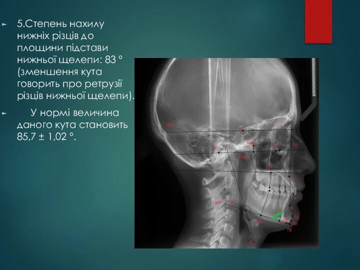 5.Степень нахилу нижніх різців до площини підстави нижньої щелепи: 83 ° (зменшення