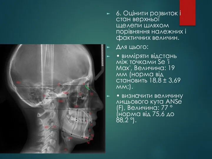 6. Оцінити розвиток і стан верхньої щелепи шляхом порівняння належних і фактичних