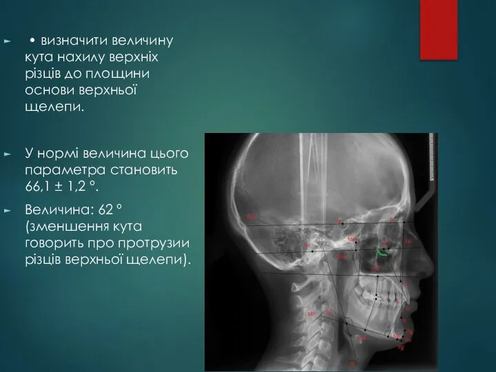 • визначити величину кута нахилу верхніх різців до площини основи верхньої щелепи.