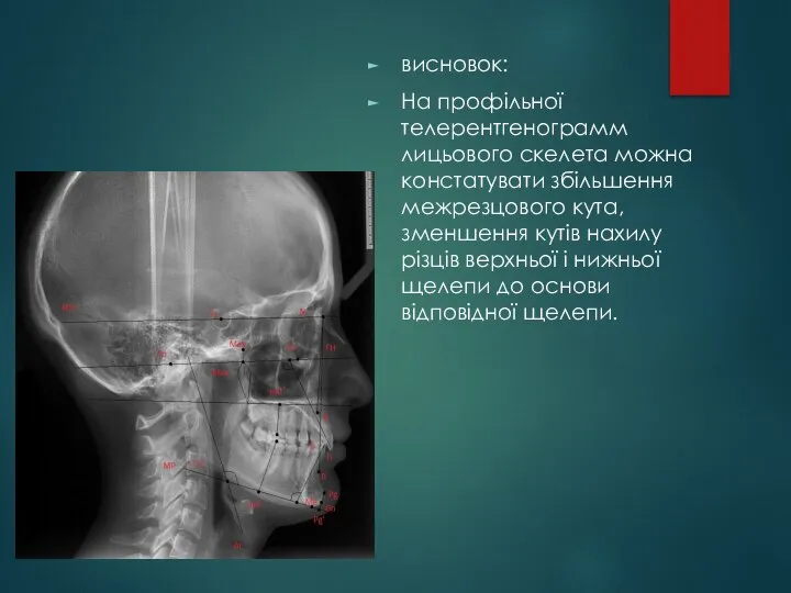 висновок: На профільної телерентгенограмм лицьового скелета можна констатувати збільшення межрезцового кута, зменшення