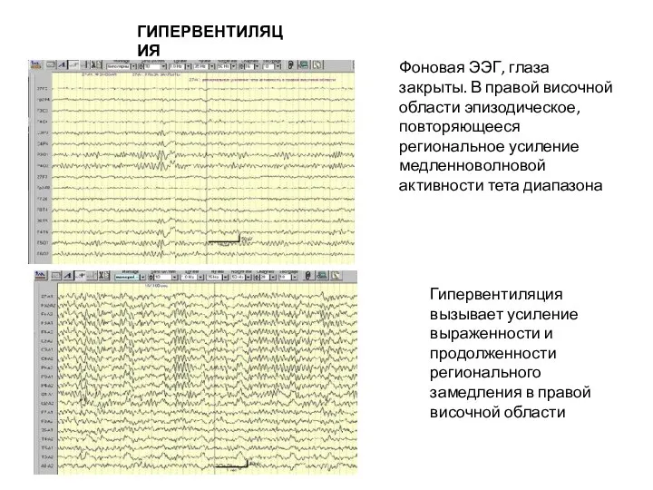 Фоновая ЭЭГ, глаза закрыты. В правой височной области эпизодическое, повторяющееся региональное усиление