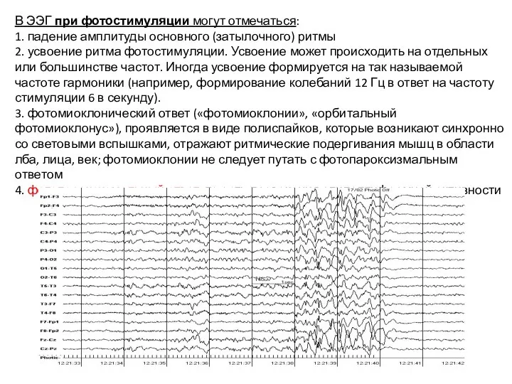 В ЭЭГ при фотостимуляции могут отмечаться: 1. падение амплитуды основного (затылочного) ритмы