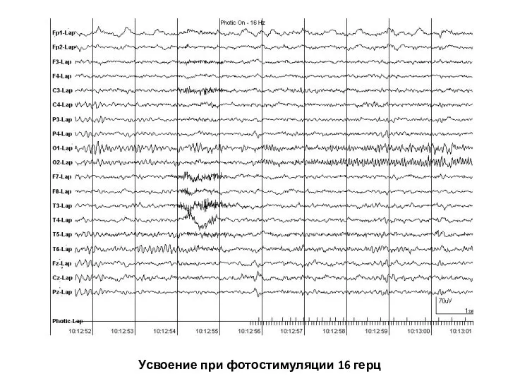 Усвоение при фотостимуляции 16 герц