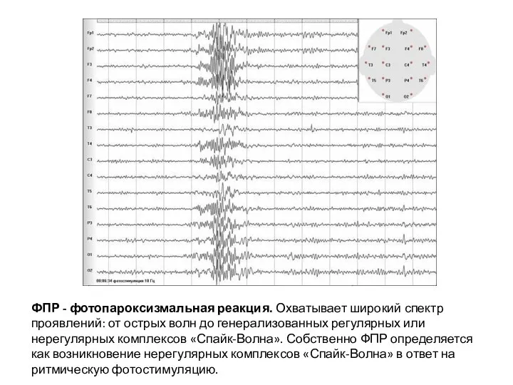 ФПР - фотопароксизмальная реакция. Охватывает широкий спектр проявлений: от острых волн до