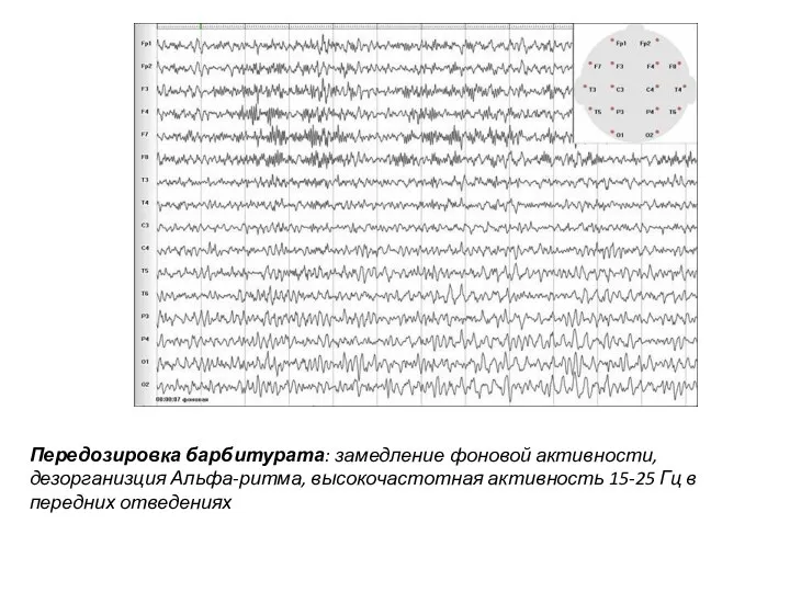 Передозировка барбитурата: замедление фоновой активности, дезорганизция Альфа-ритма, высокочастотная активность 15-25 Гц в передних отведениях