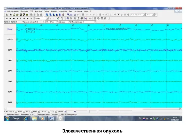 Злокачественная опухоль