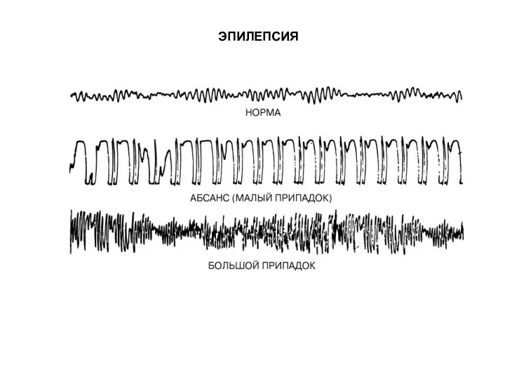 ЭПИЛЕПСИЯ