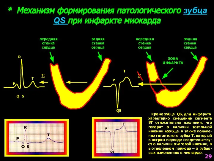 * Механизм формирования патологического зубца QS при инфаркте миокарда P Q R