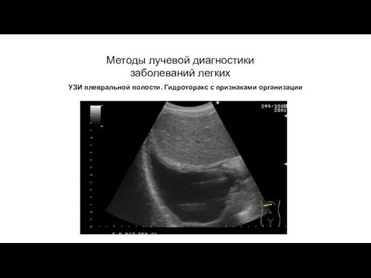 АКТУАЛЬНЫЕ ВОПРОСЫ РЕНТГЕНОЛОГИИ Методы лучевой диагностики заболеваний легких УЗИ плевральной полости. Гидроторакс с признаками организации