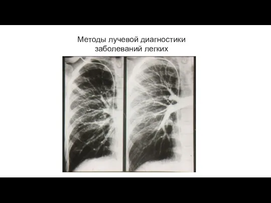 АКТУАЛЬНЫЕ ВОПРОСЫ РЕНТГЕНОЛОГИИ Методы лучевой диагностики заболеваний легких