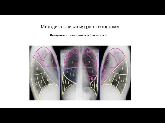 АКТУАЛЬНЫЕ ВОПРОСЫ РЕНТГЕНОЛОГИИ Методика описания рентгенограмм Рентгенанатомия легкого (сегменты)