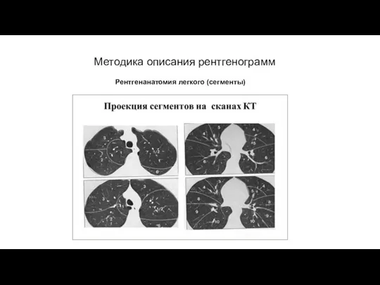 АКТУАЛЬНЫЕ ВОПРОСЫ РЕНТГЕНОЛОГИИ Методика описания рентгенограмм Рентгенанатомия легкого (сегменты)