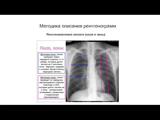 АКТУАЛЬНЫЕ ВОПРОСЫ РЕНТГЕНОЛОГИИ Методика описания рентгенограмм Рентгенанатомия легкого (поля и зоны)