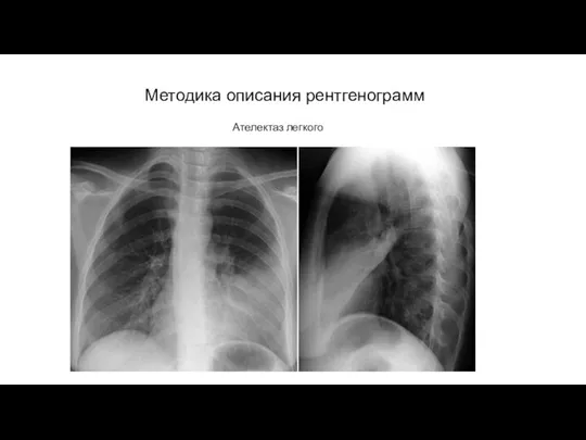 АКТУАЛЬНЫЕ ВОПРОСЫ РЕНТГЕНОЛОГИИ Методика описания рентгенограмм Ателектаз легкого