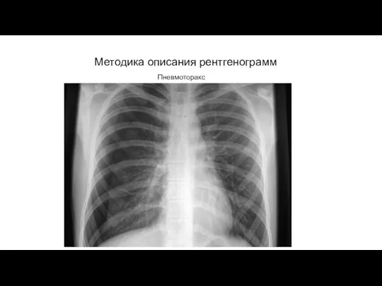 АКТУАЛЬНЫЕ ВОПРОСЫ РЕНТГЕНОЛОГИИ Методика описания рентгенограмм Пневмоторакс