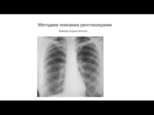 АКТУАЛЬНЫЕ ВОПРОСЫ РЕНТГЕНОЛОГИИ Методика описания рентгенограмм Анализ корня легкого