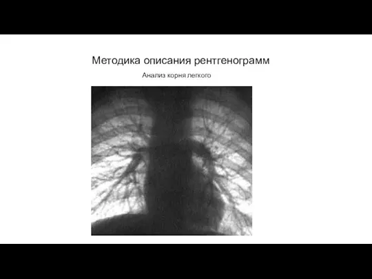 АКТУАЛЬНЫЕ ВОПРОСЫ РЕНТГЕНОЛОГИИ Методика описания рентгенограмм Анализ корня легкого