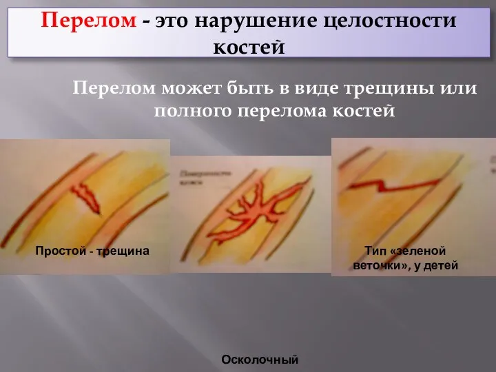 Перелом - это нарушение целостности костей Перелом может быть в виде трещины