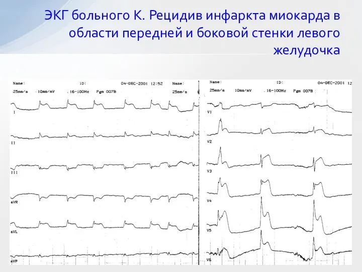 ЭКГ больного К. Рецидив инфаркта миокарда в области передней и боковой стенки левого желудочка