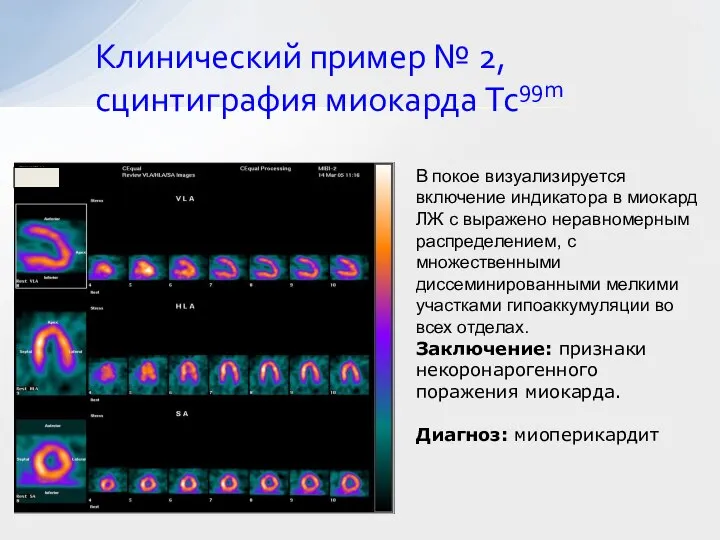 Клинический пример № 2, сцинтиграфия миокарда Tc99m В покое визуализируется включение индикатора