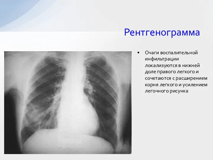 Рентгенограмма Очаги воспалительной инфильтрации локализуются в нижней доле правого легкого и сочетаются