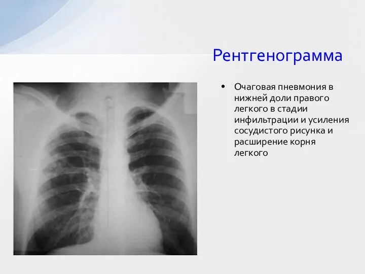 Рентгенограмма Очаговая пневмония в нижней доли правого легкого в стадии инфильтрации и