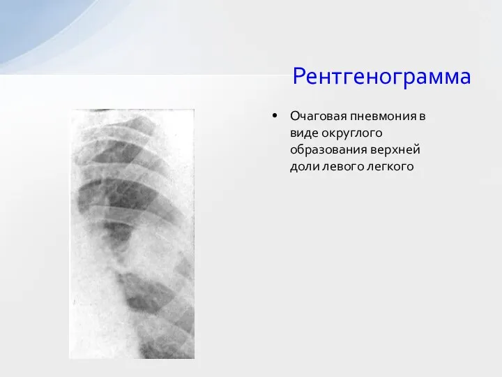 Рентгенограмма Очаговая пневмония в виде округлого образования верхней доли левого легкого
