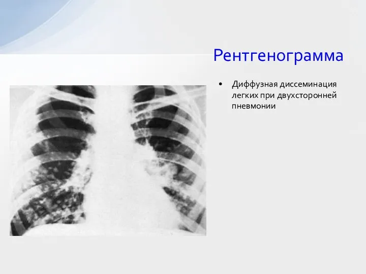 Рентгенограмма Диффузная диссеминация легких при двухсторонней пневмонии