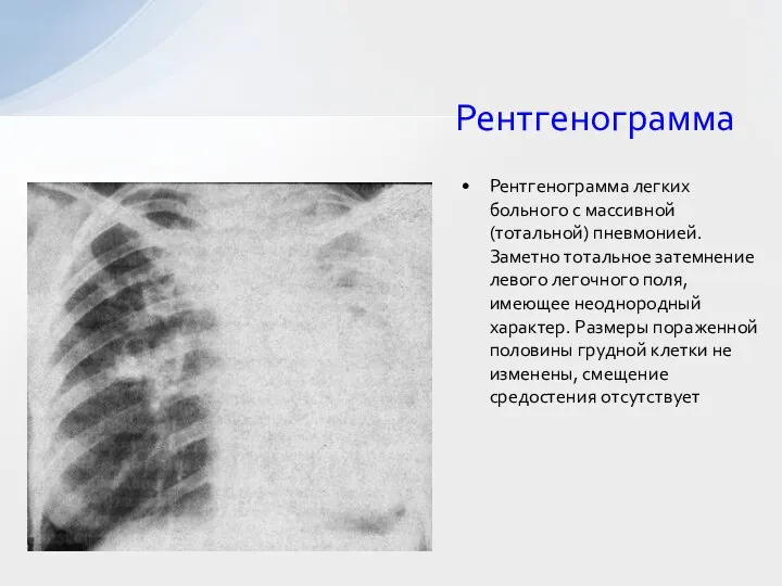 Рентгенограмма Рентгенограмма легких больного с массивной (тотальной) пневмонией. Заметно тотальное затемнение левого
