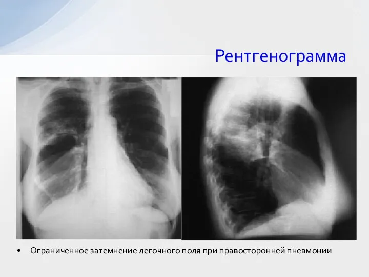 Рентгенограмма Ограниченное затемнение легочного поля при правосторонней пневмонии