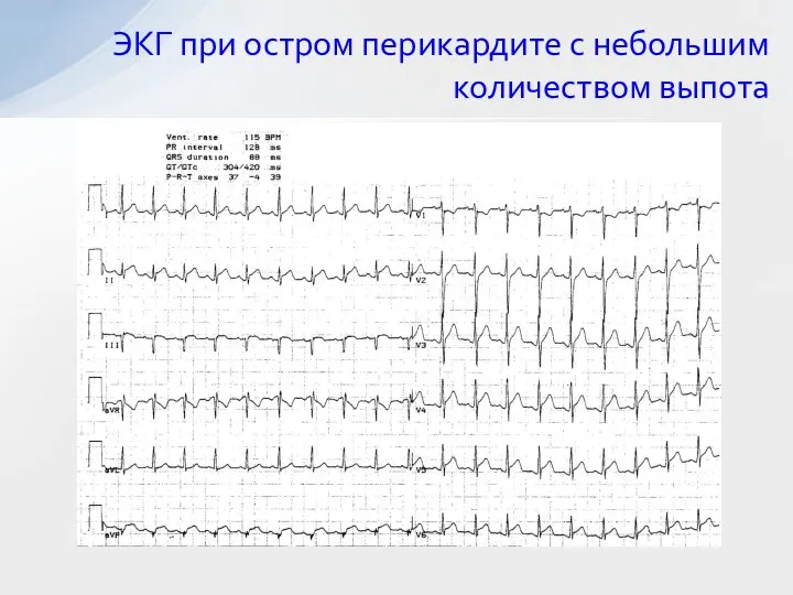 ЭКГ при остром перикардите с небольшим количеством выпота