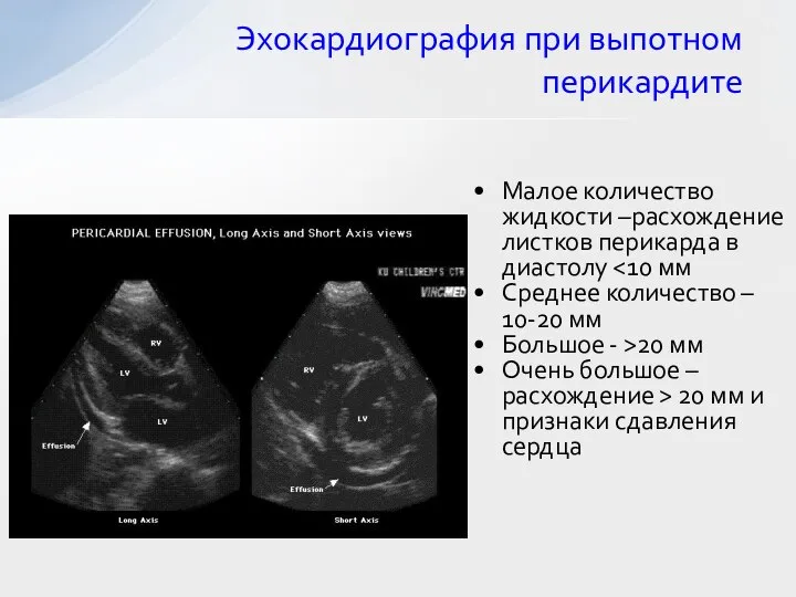 Эхокардиография при выпотном перикардите Малое количество жидкости –расхождение листков перикарда в диастолу