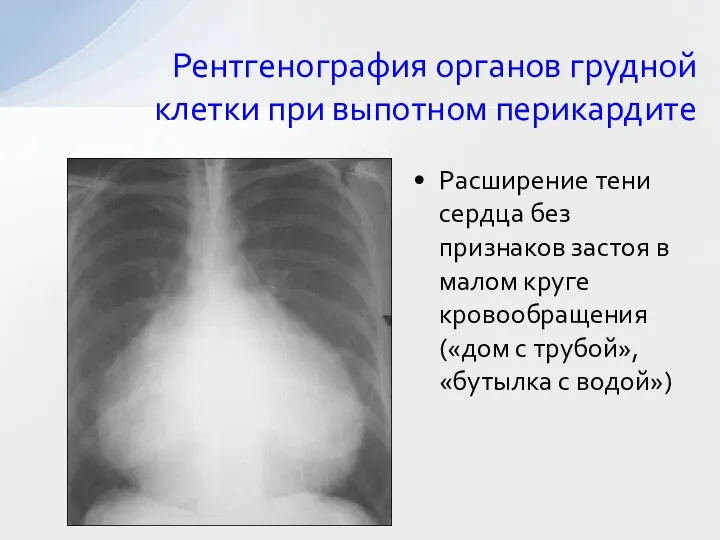 Рентгенография органов грудной клетки при выпотном перикардите Расширение тени сердца без признаков