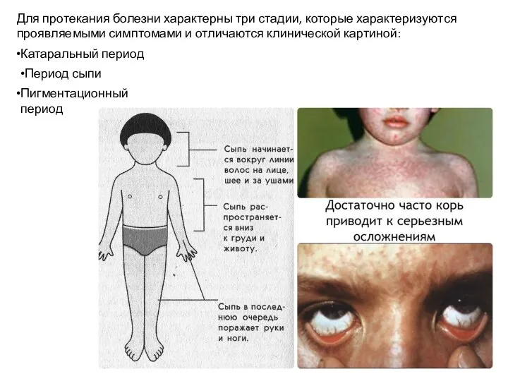 Для протекания болезни характерны три стадии, которые характеризуются проявляемыми симптомами и отличаются