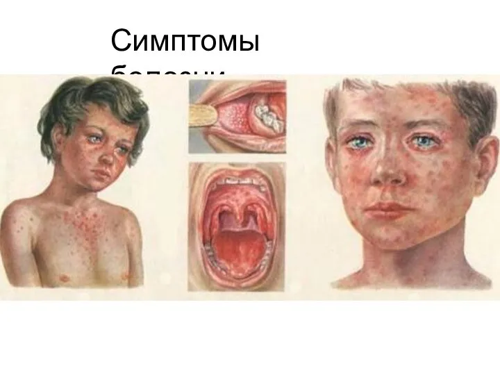 Симптомы болезни