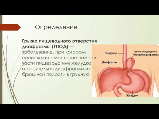 Определение Грыжа пищеводного отверстия диафрагмы (ГПОД) — заболевание, при котором происходит смещение