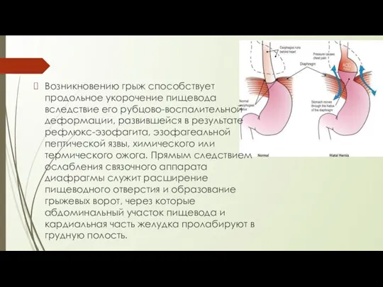 Возникновению грыж способствует продольное укорочение пищевода вследствие его рубцово-воспалительной деформации, развившейся в