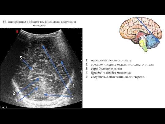F6- сканирование в области теменной доли, височной и мозжечка 1 2 3