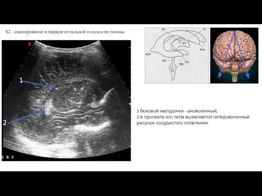 S2 - сканирование в парасагиттальной плоскости головы 1 2 1 боковой желудочек