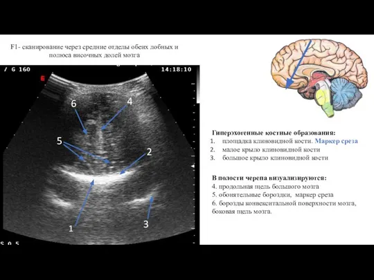 F1- сканирование через средние отделы обеих лобных и полюса височных долей мозга