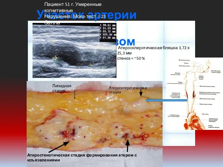 Участок артерии поражённой атеросклерозом Липидная стадия Атеросклеротическая стадия Атеростенотическая стадия формирования атером