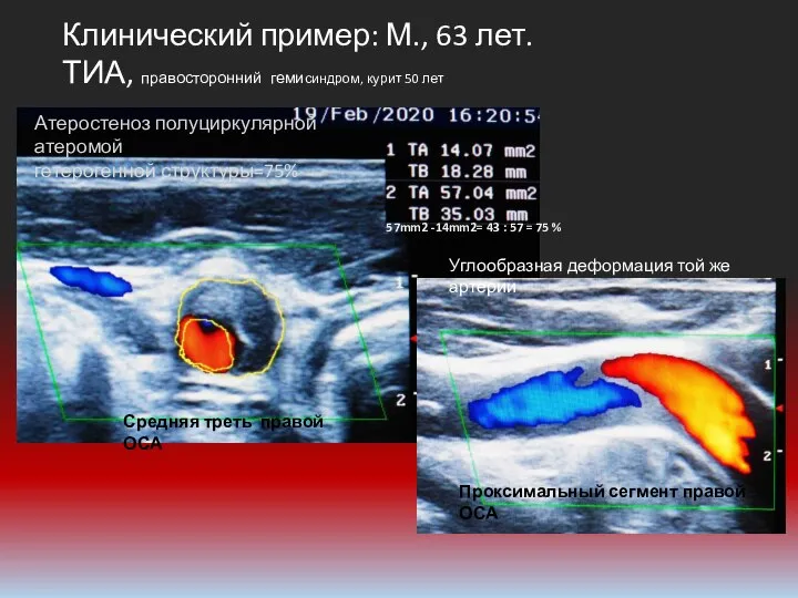 Клинический пример: М., 63 лет. ТИА, правосторонний гемисиндром, курит 50 лет Проксимальный