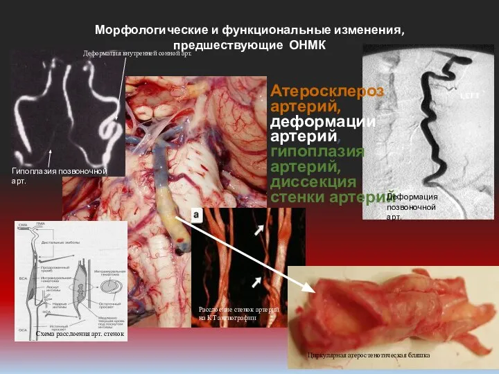 Атеросклероз артерий, деформации артерий, гипоплазия артерий, диссекция стенки артерий Морфологические и функциональные