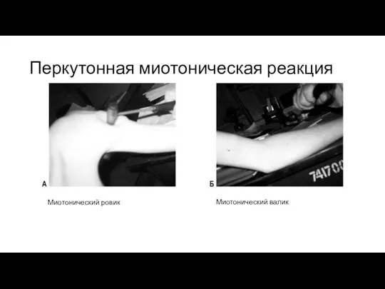 Перкутонная миотоническая реакция Миотонический ровик Миотонический валик