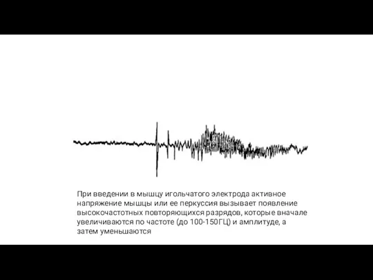 При введении в мышцу игольчатого электрода активное напряжение мышцы или ее перкуссия