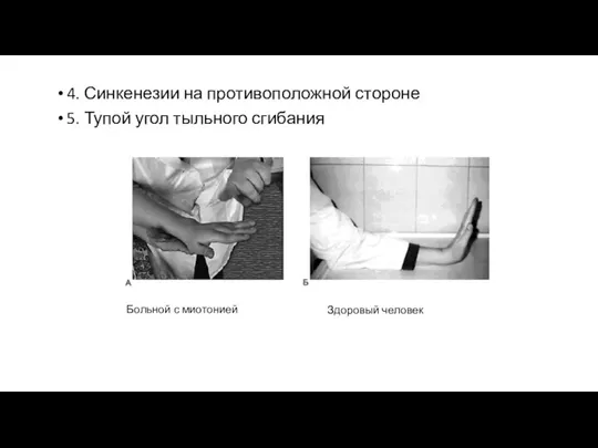 4. Синкенезии на противоположной стороне 5. Тупой угол тыльного сгибания Больной с миотонией Здоровый человек