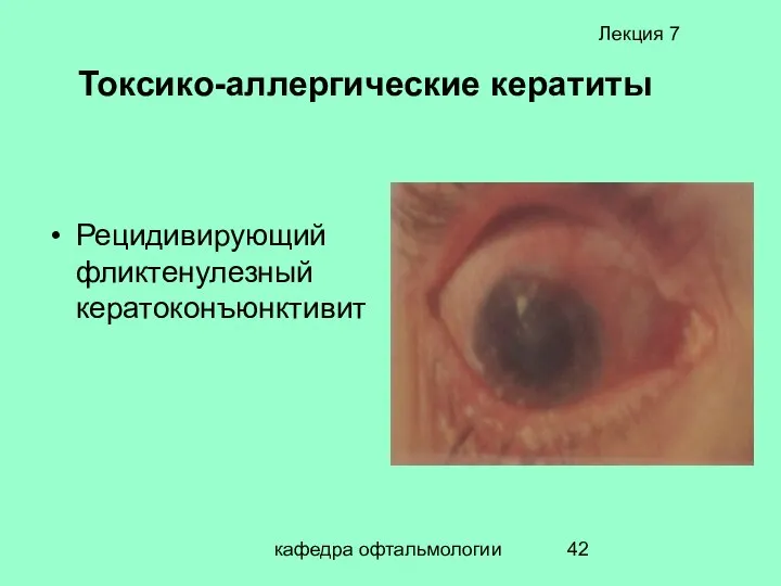 кафедра офтальмологии Рецидивирующий фликтенулезный кератоконъюнктивит Лекция 7 Токсико-аллергические кератиты